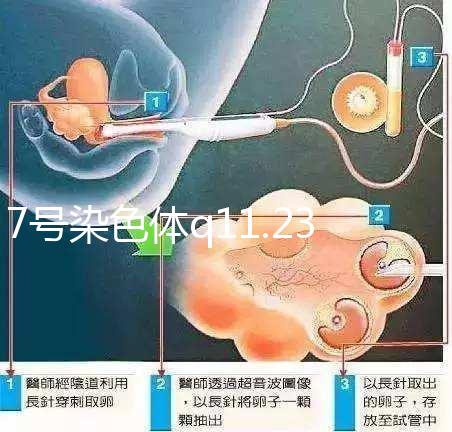 7號染色體q11.23重復綜合征患者智力水平低下,能治療嗎?
